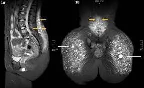 VASER Technology Machine