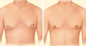 gynecomastia-surgery-with-vaser