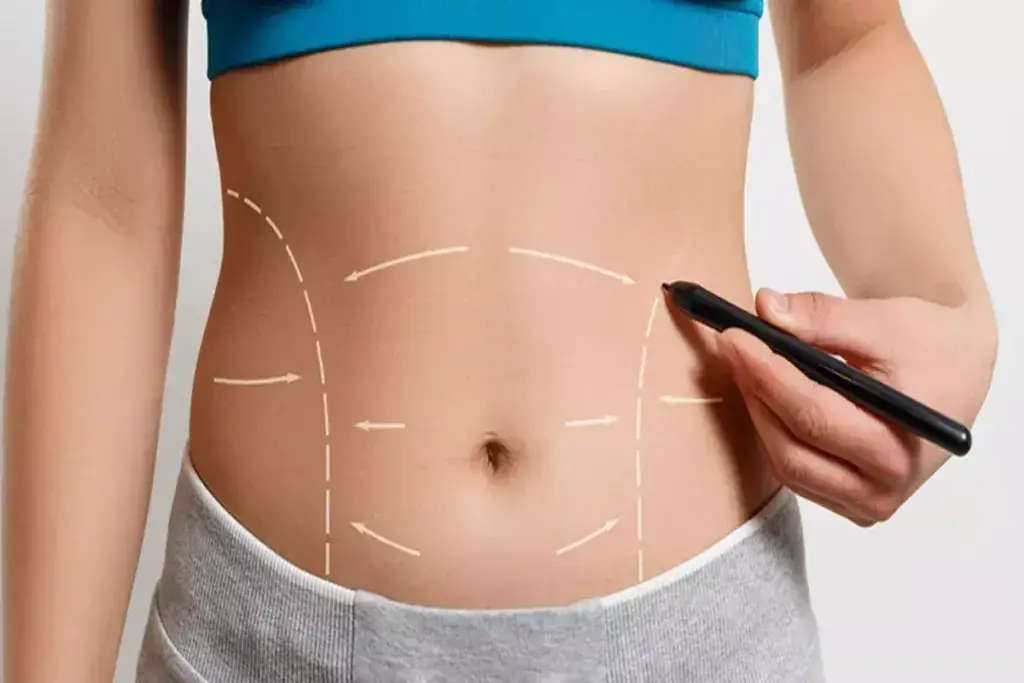 ideal-candidate-for-vaser-liposuction