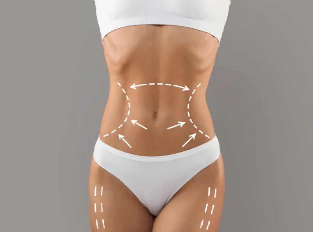 tissue-preservation-in-vaser-liposuction