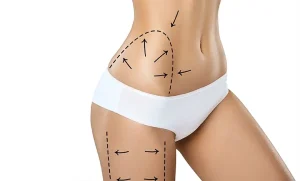 vaser-liposuction-for-abdomen