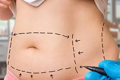 vaser-liposuction-vs-traditional-liposuction-perfect-body-contouring