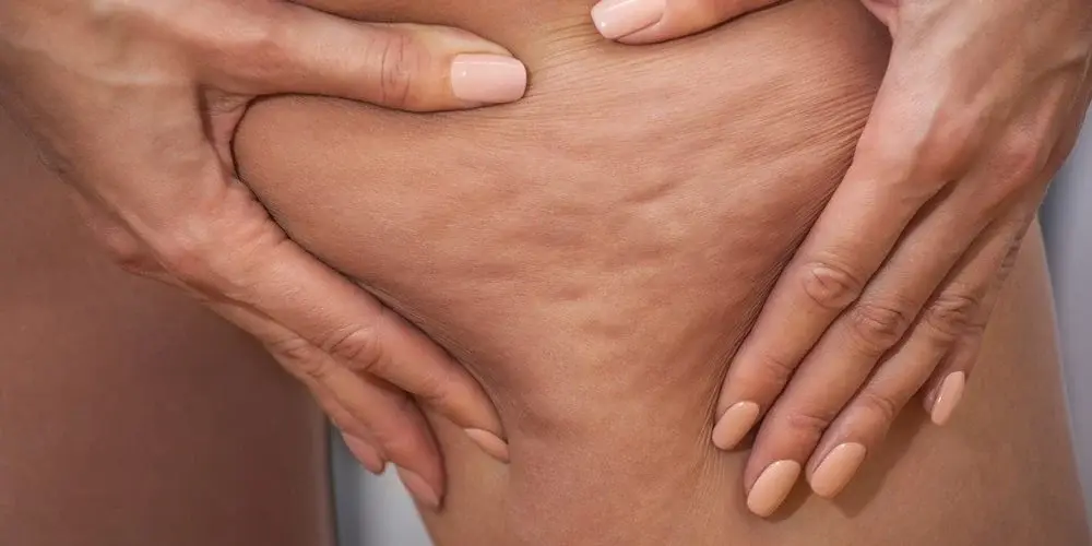 what-is-liposuction-for-cellulite