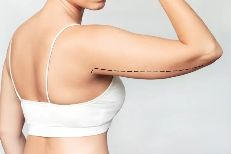 Can Liposuction Treat Arm Fat That Won’t Go Away? Understanding Arm Liposuction and Body Contouring