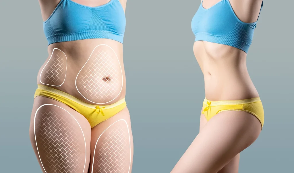 liposuction-for-love-handles-and-waist-contouring