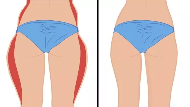 Can Liposuction Help Reduce Saddlebag Fat? Understanding the Causes and Treatment Options