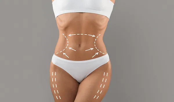 Why Waist Contouring Is One of the Most Popular Liposuction Treatments