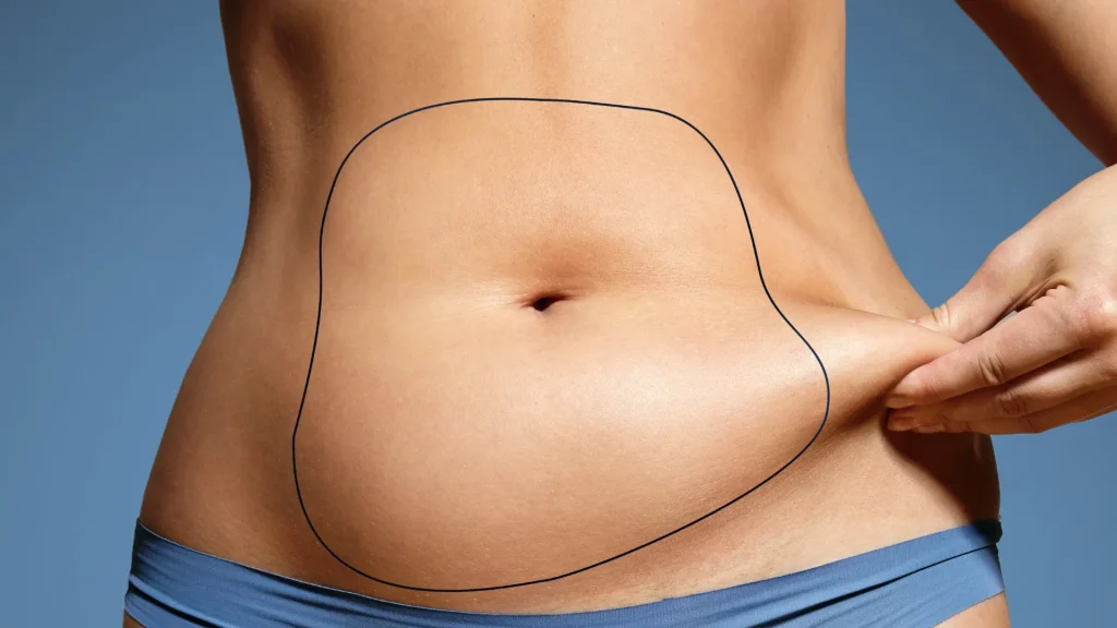 Abdominal Liposuction: Everything You Need to Know