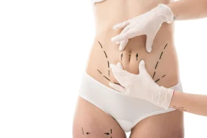 Abdominal Liposuction: Who Is a Good Candidate for Better Body Contouring?