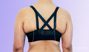 Can Liposuction Reduce Bra Bulge Fat?