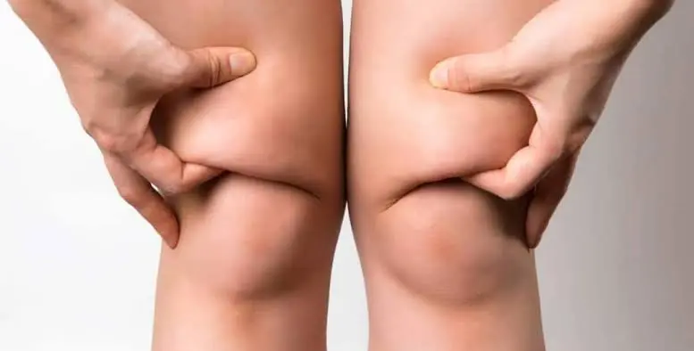knee-liposuction