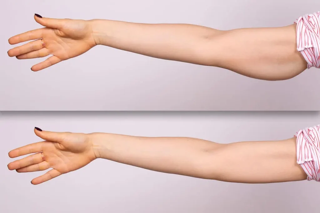 upper-arm-liposuction