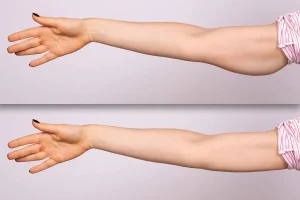 Can VASER Liposuction Improve Arm Contours?